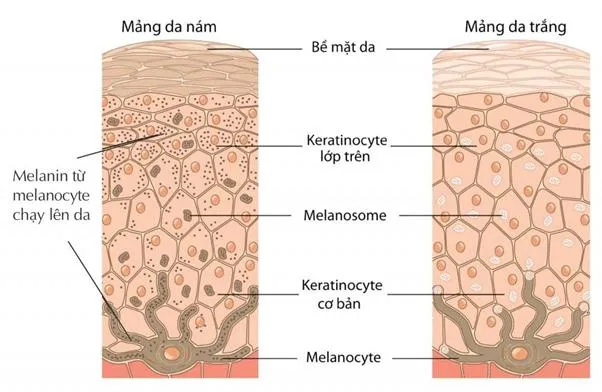 8 thuốc trị nám mảng, nám chân sâu tốt nhất hiện nay