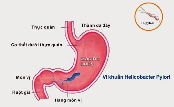 Đau bụng trên rốn là bệnh gì?