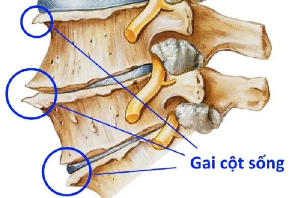 Gai cột sống và những nguyên tắc dinh dưỡng khoa học