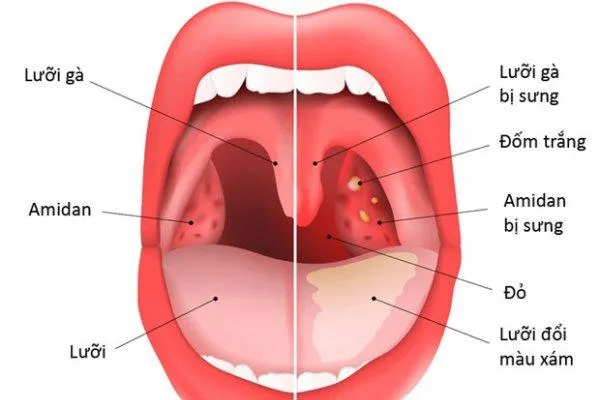 Người bị đau họng nên ăn gì và kiêng gì?