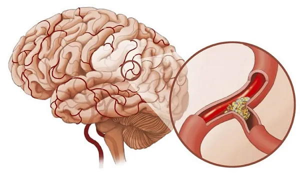 Phòng ngừa xuất huyết não từ những dấu hiệu đơn giản nhất